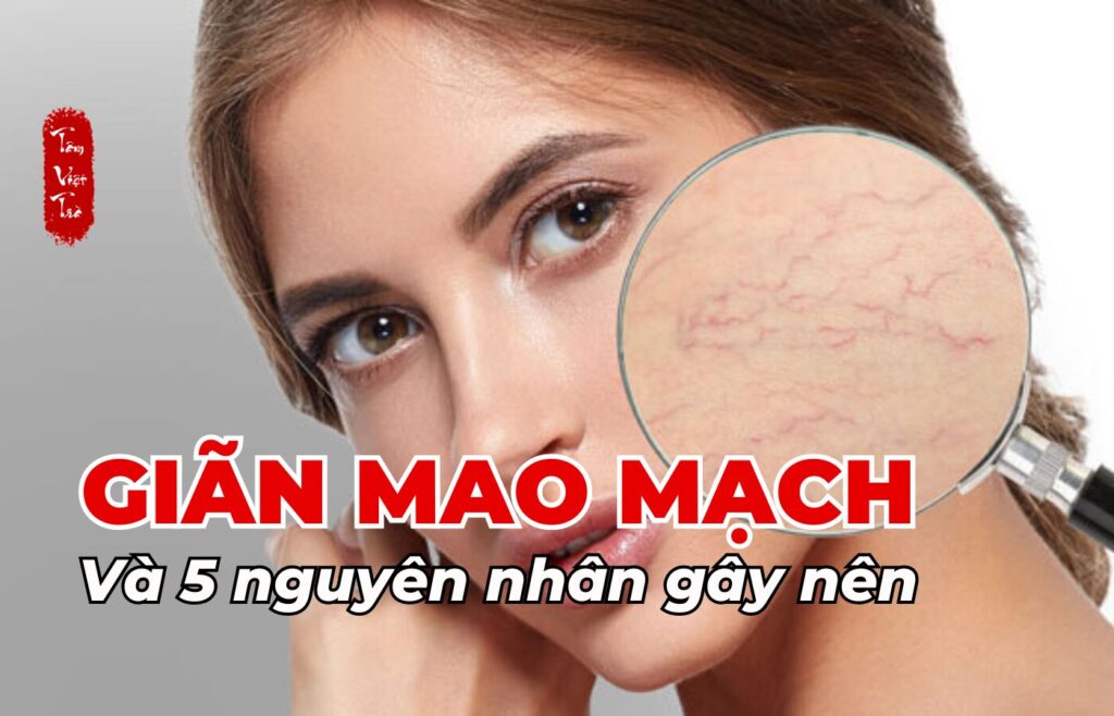 Giãn mao mạch và 5 nguyên nhân gây nên