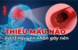 Thiếu máu não và 13 nguyên nhân gây nên