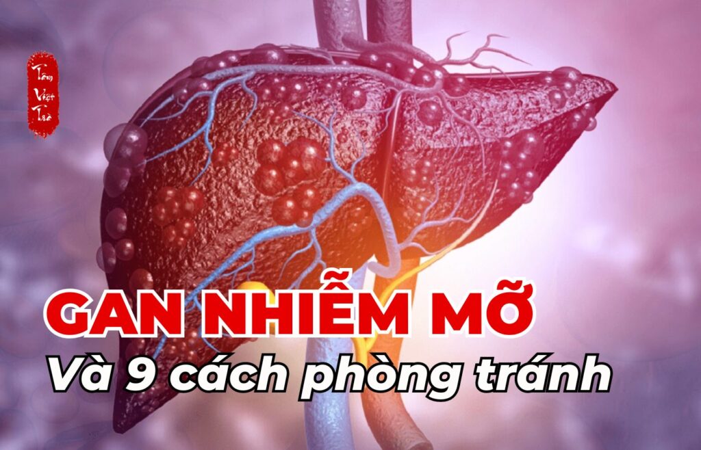 Gan nhiễm mỡ và 9 cách phòng tránh