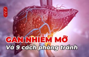 Gan nhiễm mỡ và 9 cách phòng tránh