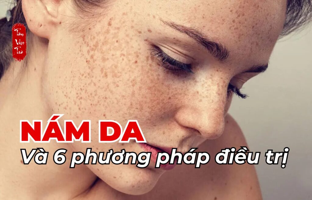 Nám da và 6 phương pháp điều trị