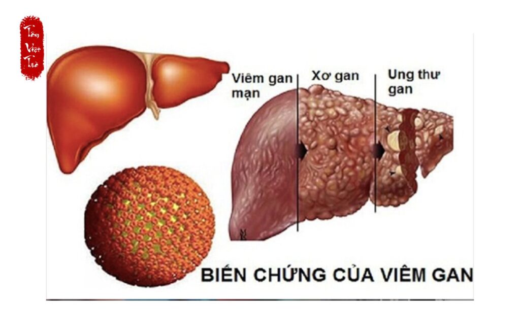 Viêm gan B và 11 cách phòng tránh