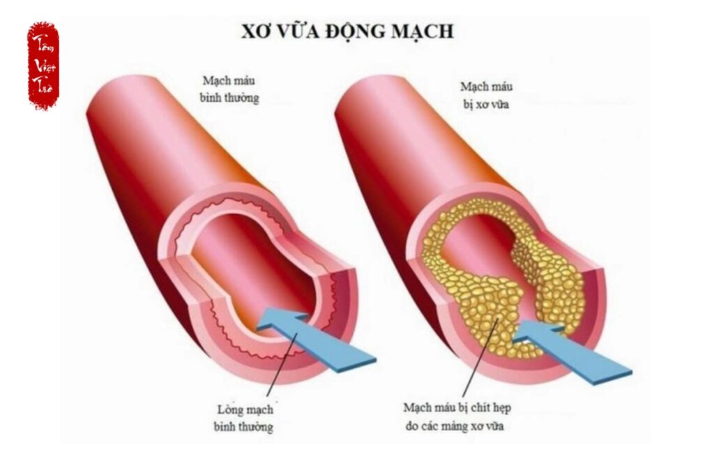 Thiếu máu não và 13 nguyên nhân gây nên