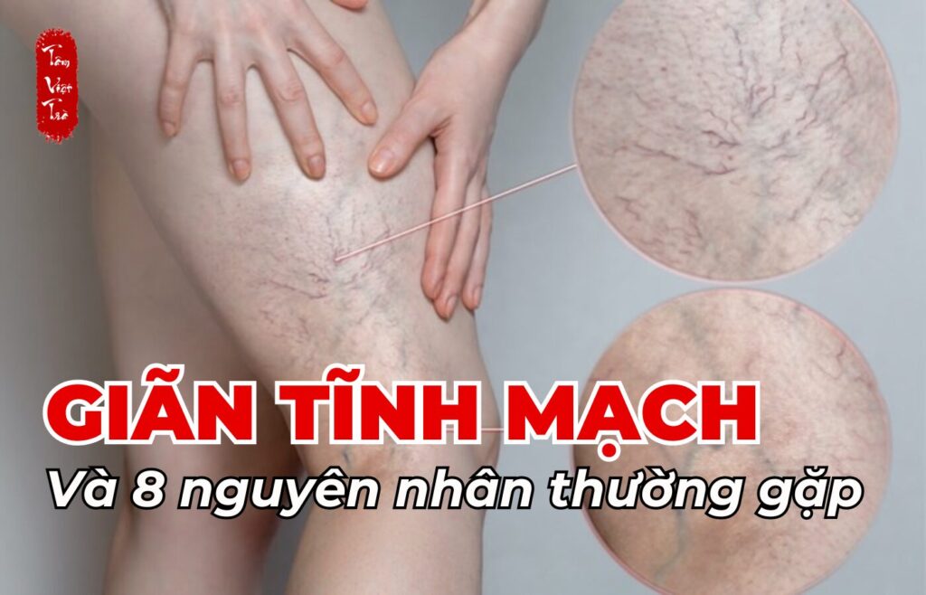 Giãn tĩnh mạch và 8 nguyên nhân thường gặp