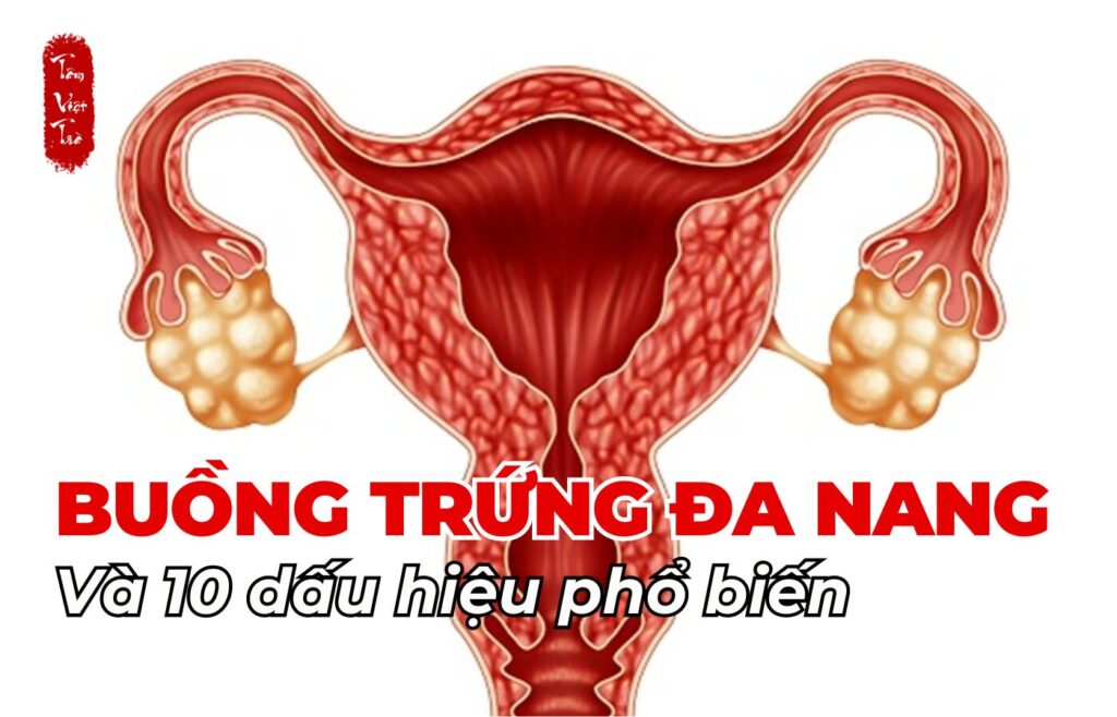 Buồng trứng đa nang và 10 dấu hiệu phổ biến