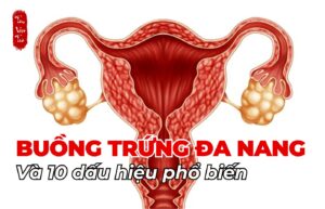 Buồng trứng đa nang và 10 dấu hiệu phổ biến